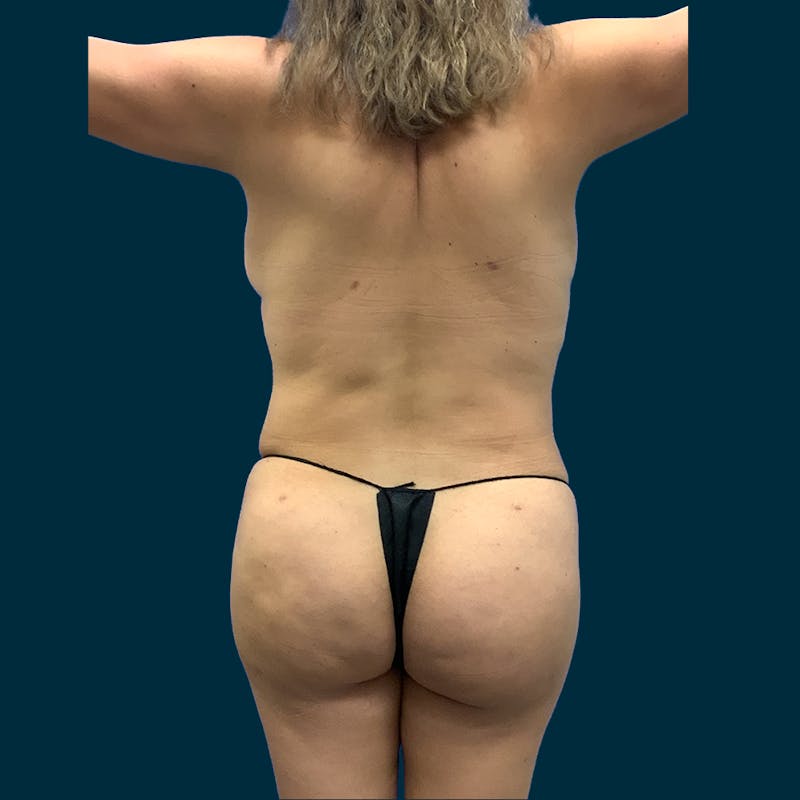 Fat Transfer Before & After Gallery - Patient 321737 - Image 2