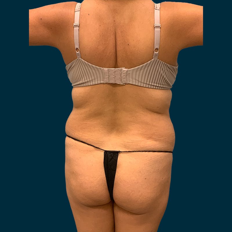 Liposuction Before & After Gallery - Patient 326743 - Image 1