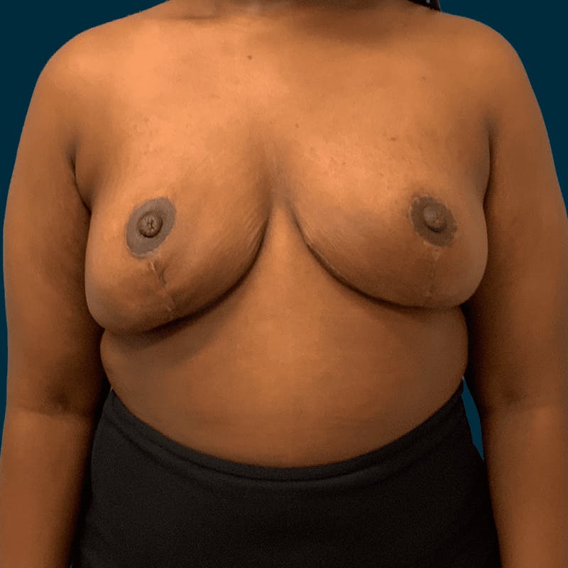 Breast Reduction Before & After Gallery - Patient 280905 - Image 2