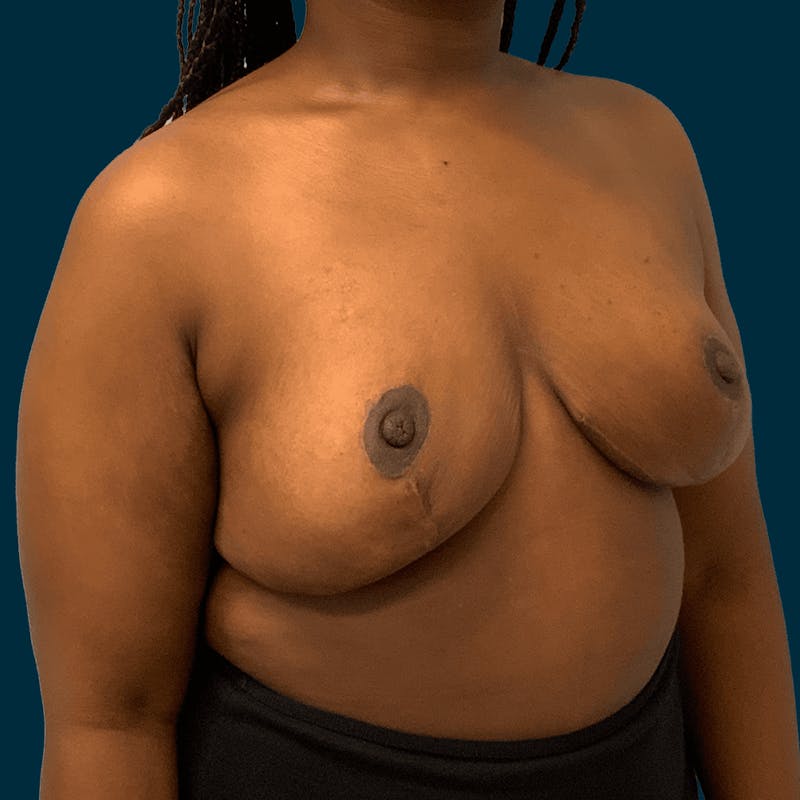 Breast Reduction Before & After Gallery - Patient 280905 - Image 4