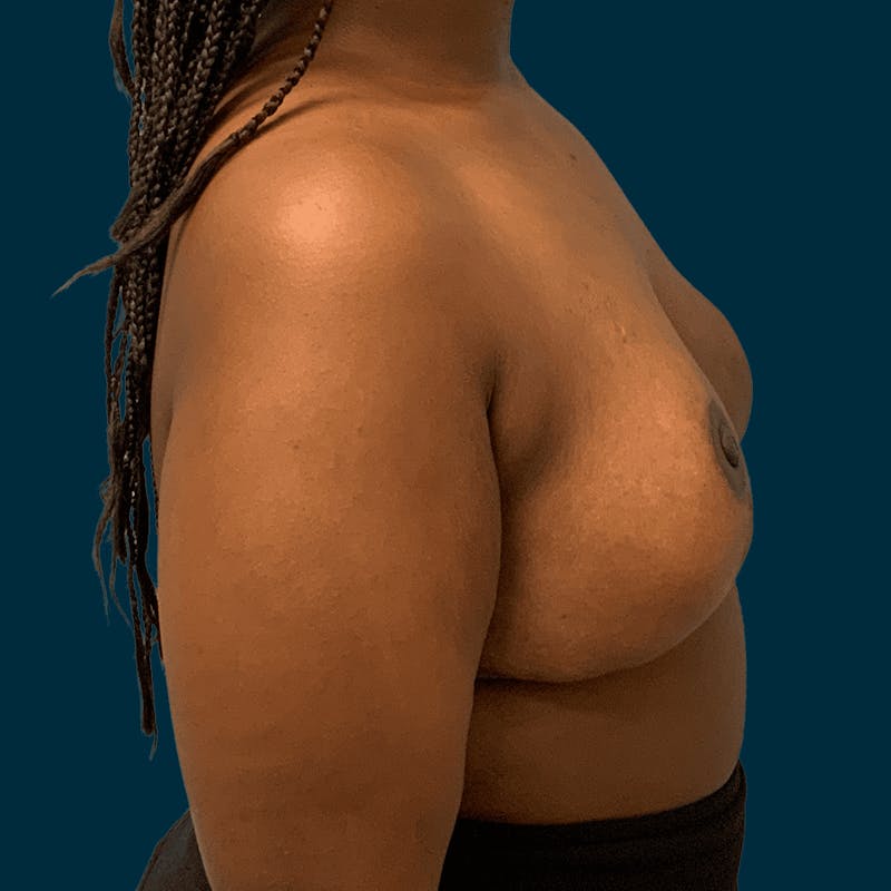 Breast Reduction Before & After Gallery - Patient 280905 - Image 8