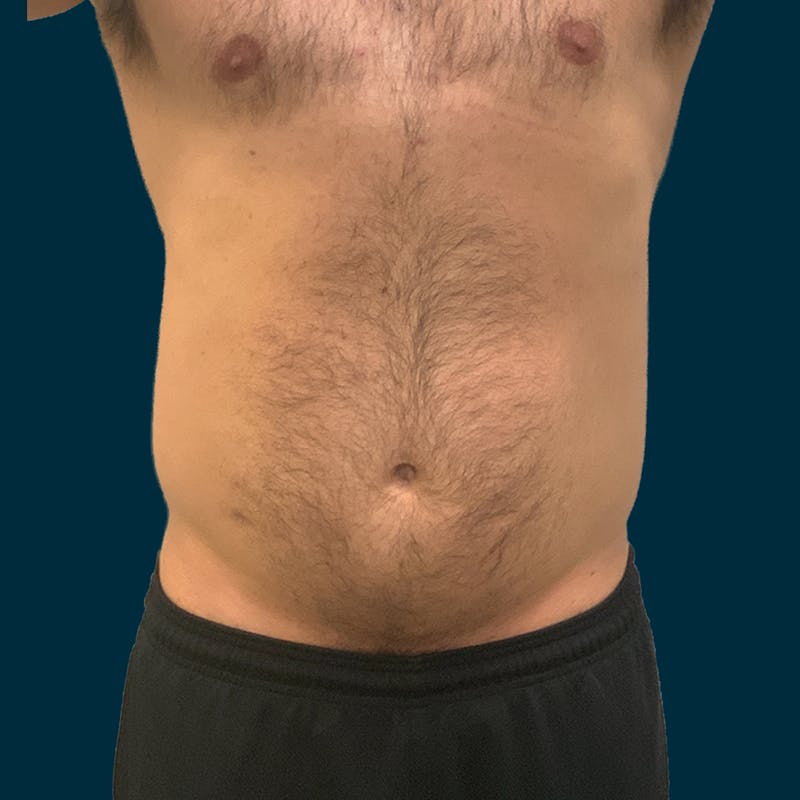 Liposuction Before & After Gallery - Patient 192809 - Image 1