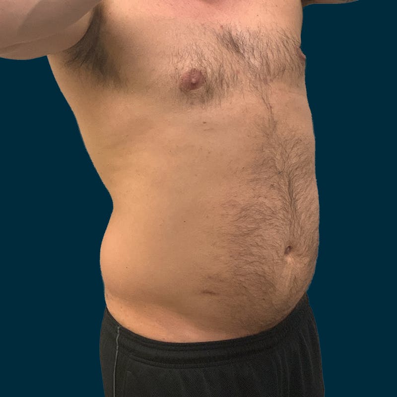Liposuction Before & After Gallery - Patient 192809 - Image 3