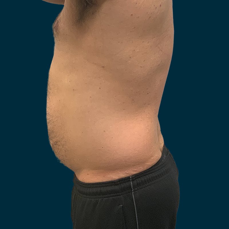 Liposuction Before & After Gallery - Patient 192809 - Image 5
