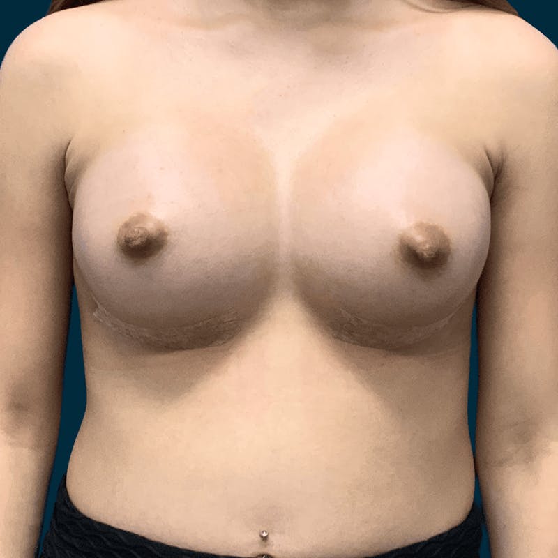 Breast Augmentation Before & After Gallery - Patient 155092 - Image 2