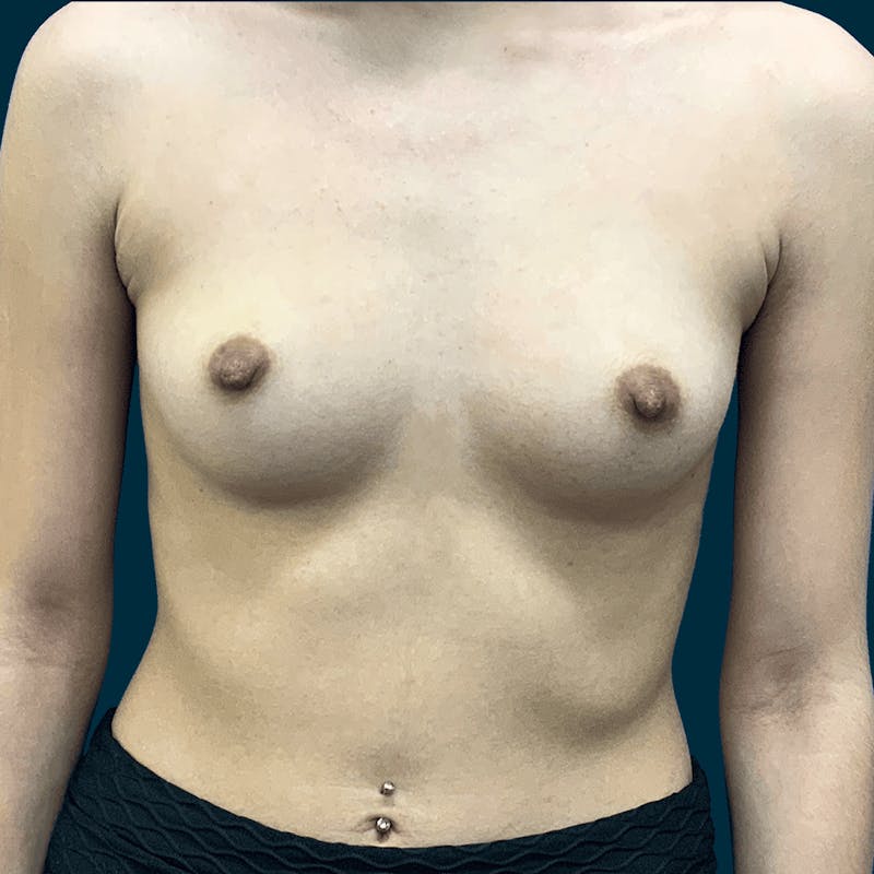 Patient NC-rj3yUSsWasOw5PllbUw - Breast Augmentation Before & After Photos