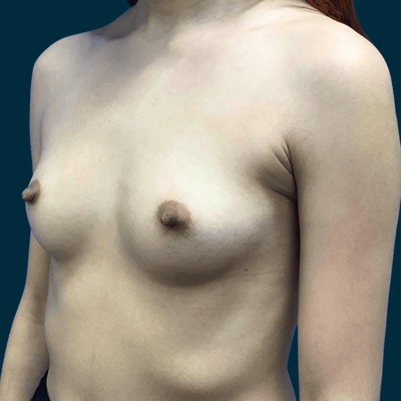 Breast Augmentation Before & After Gallery - Patient 155092 - Image 3