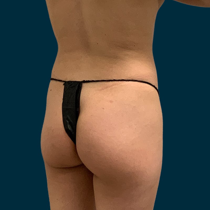 Brazilian Butt Lift Before & After Gallery - Patient 427404 - Image 3