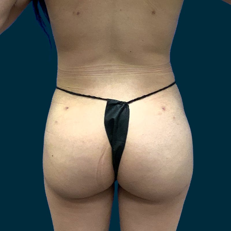 Brazilian Butt Lift Before & After Gallery - Patient 427404 - Image 2