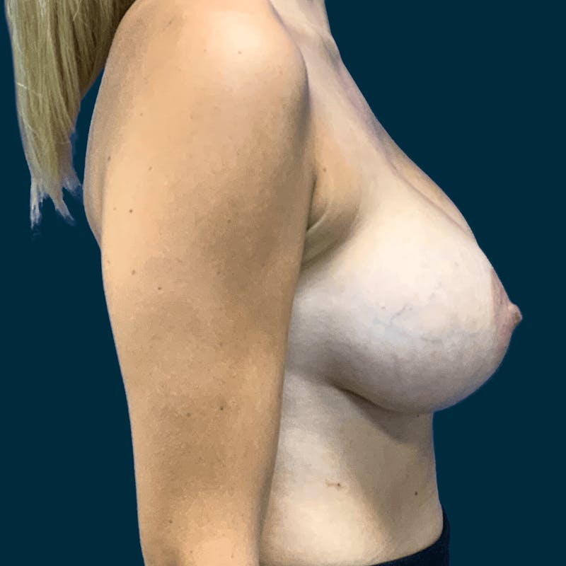 Breast Lift Before & After Gallery - Patient 474672 - Image 6