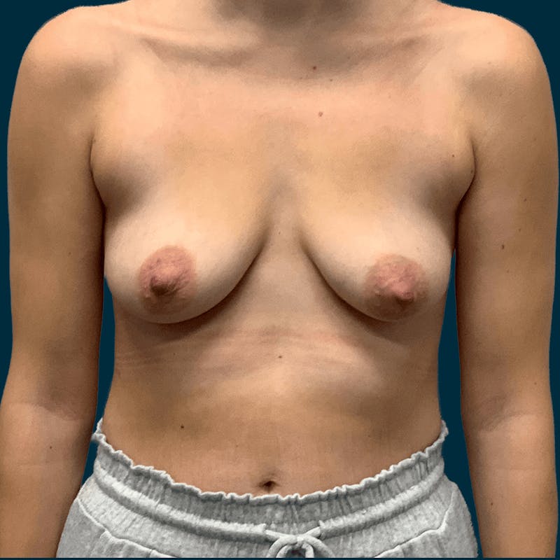 Breast Lift Before & After Gallery - Patient 474672 - Image 1