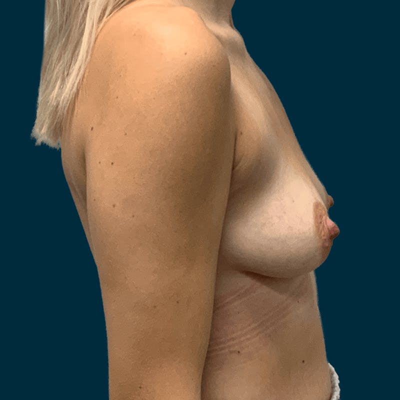 Breast Lift Before & After Gallery - Patient 474672 - Image 5