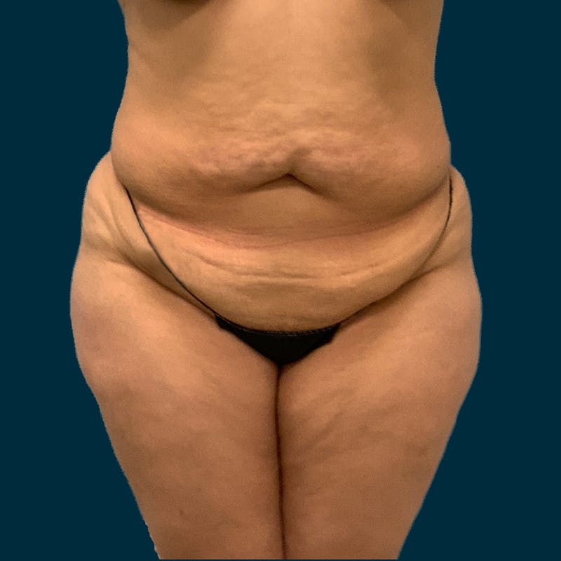 Liposuction Before & After Gallery - Patient 312508 - Image 1
