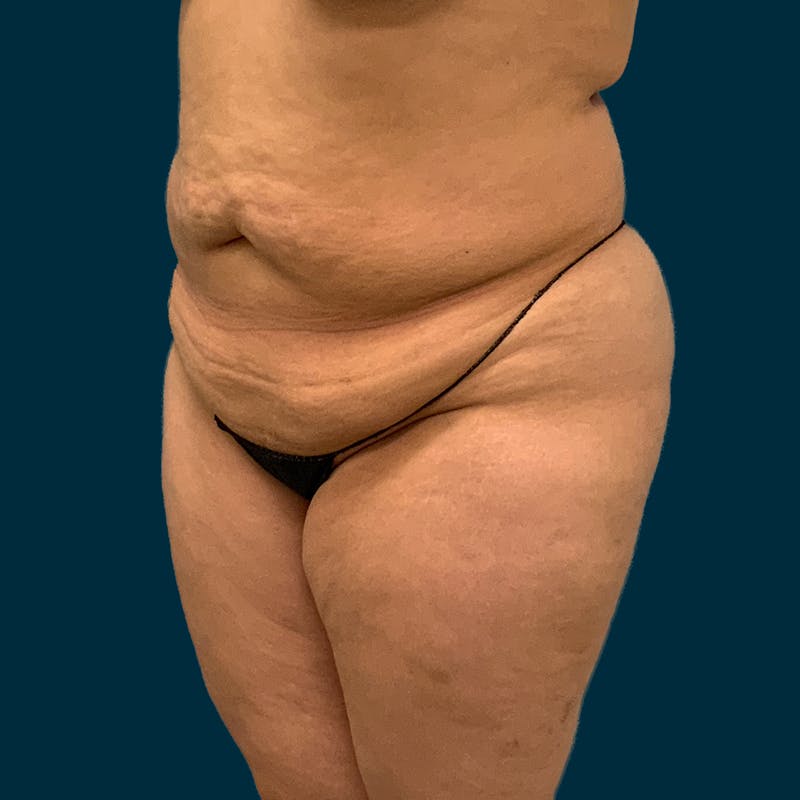 Liposuction Before & After Gallery - Patient 312508 - Image 3