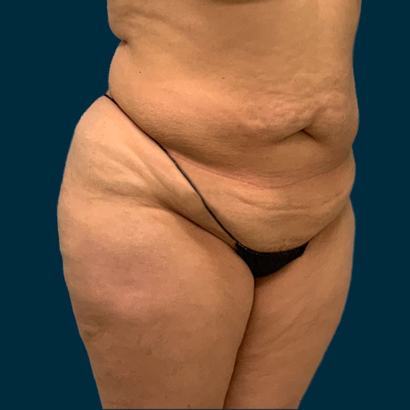 Abdominoplasty Before & After Gallery - Patient 157694 - Image 5