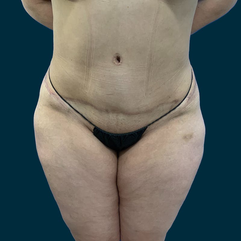 Liposuction Before & After Gallery - Patient 312508 - Image 2