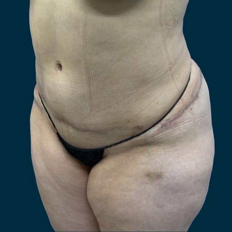 Abdominoplasty Before & After Gallery - Patient 157694 - Image 4