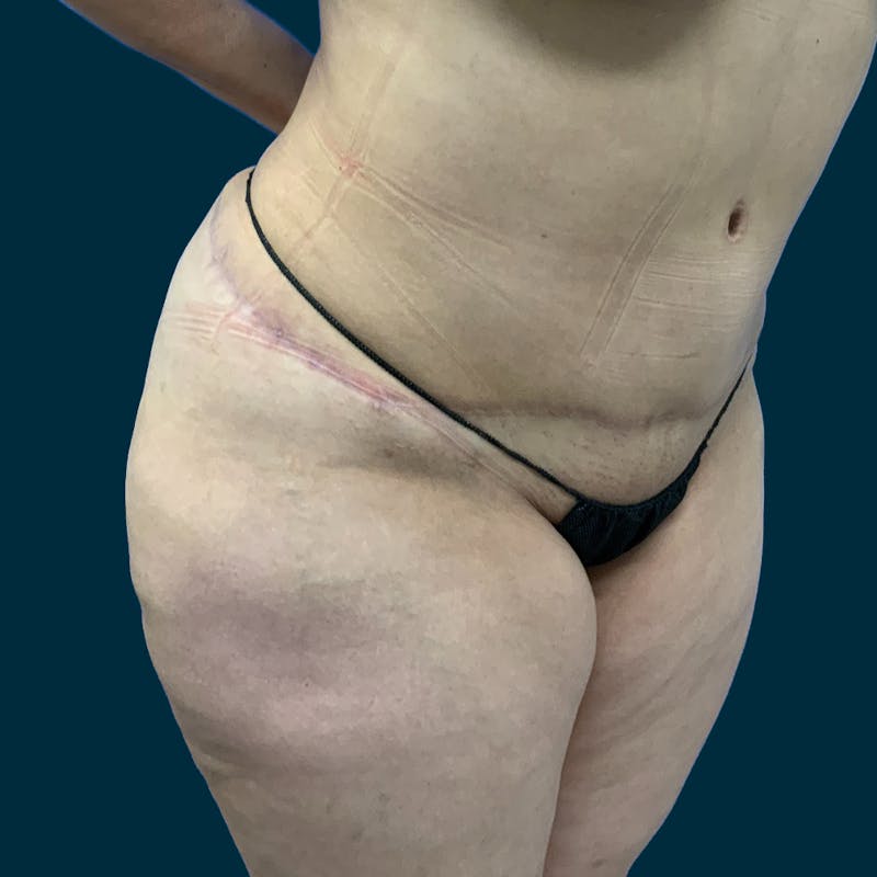 Abdominoplasty Before & After Gallery - Patient 157694 - Image 6