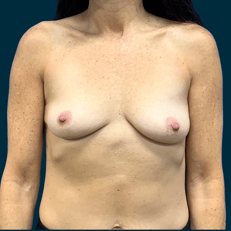 Breast Augmentation Before & After Gallery - Patient 260747 - Image 1
