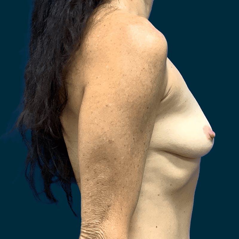 Breast Augmentation Before & After Gallery - Patient 260747 - Image 5