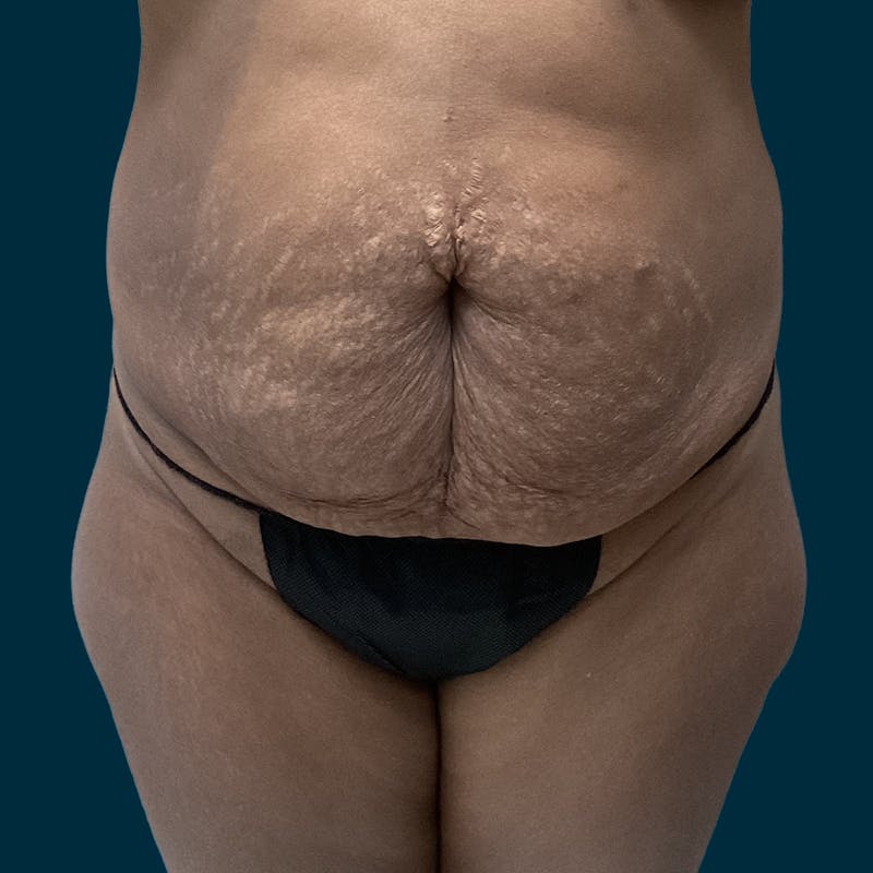 Patient RiL0d5ctSTuso4t8WwddZA - Tummy Tuck Before & After Photos