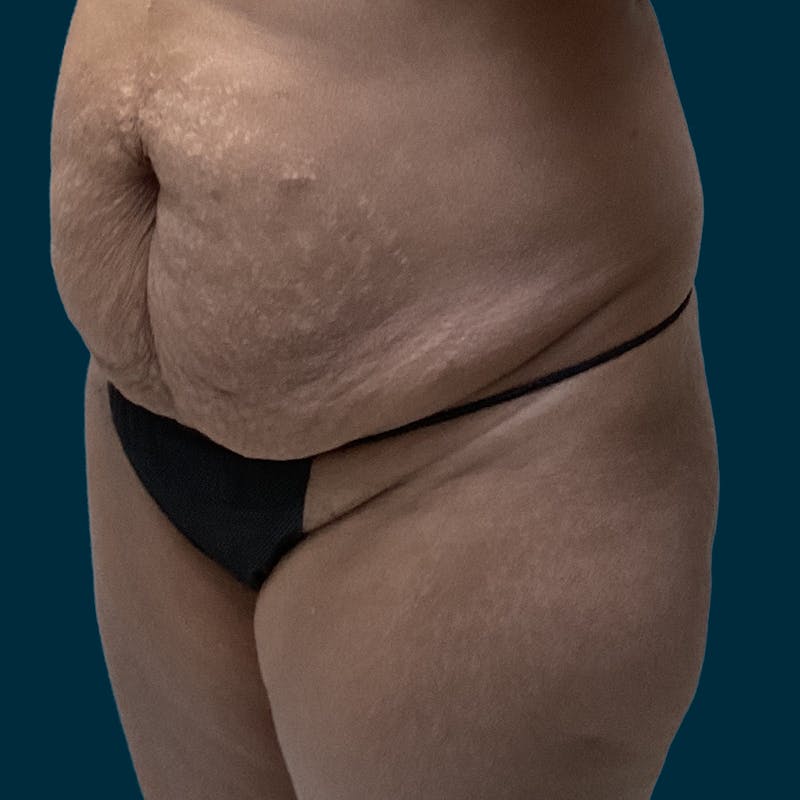 Abdominoplasty Before & After Gallery - Patient 467989 - Image 3