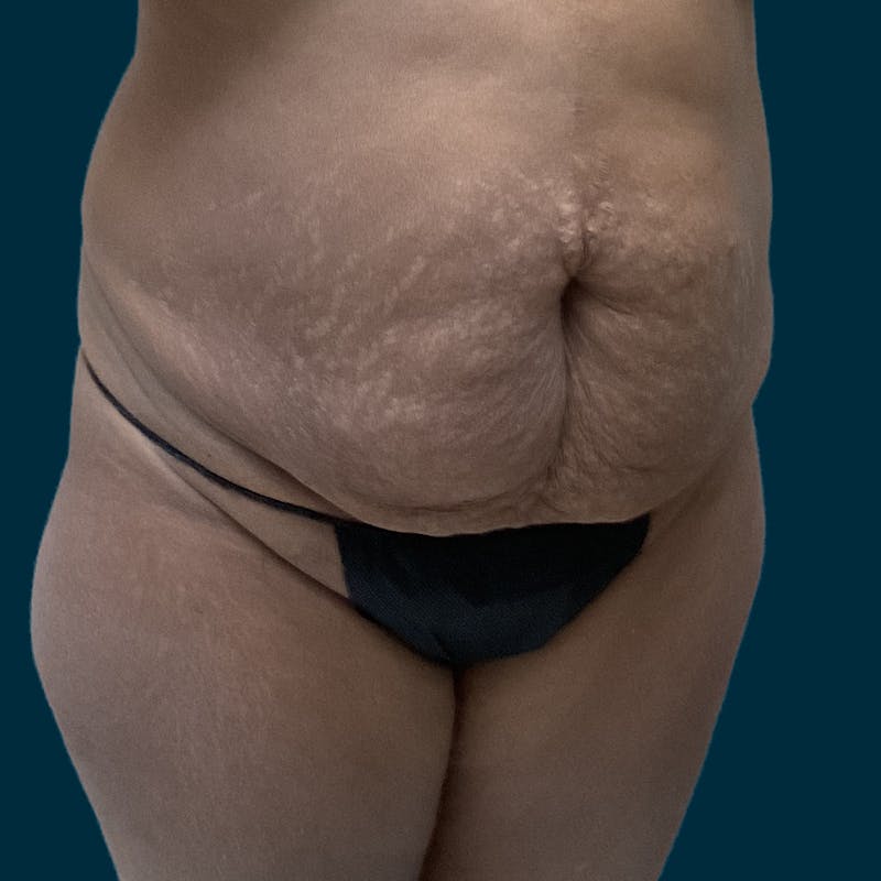 Abdominoplasty Before & After Gallery - Patient 467989 - Image 5
