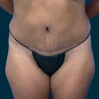 Abdominoplasty Before & After Gallery - Patient 467989 - Image 2