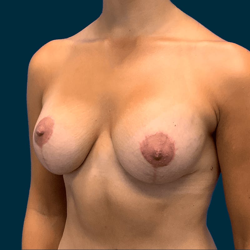 Breast Lift Before & After Gallery - Patient 314514 - Image 4