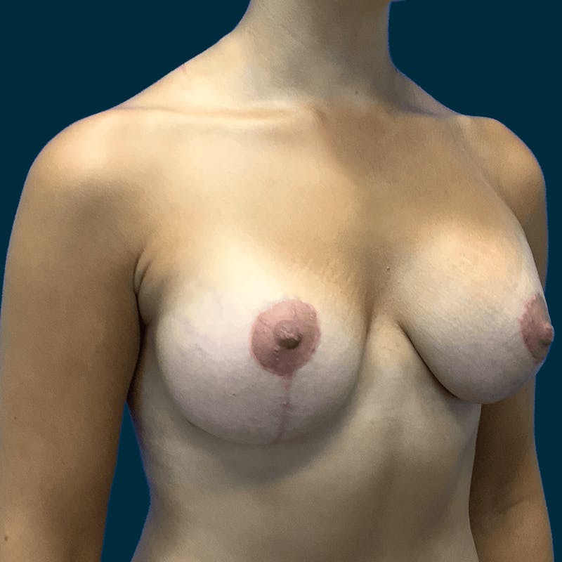Breast Lift Before & After Gallery - Patient 314514 - Image 6
