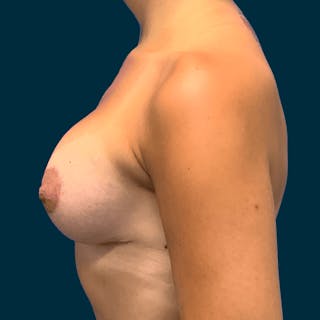 Breast Lift Before & After Gallery - Patient 314514 - Image 8
