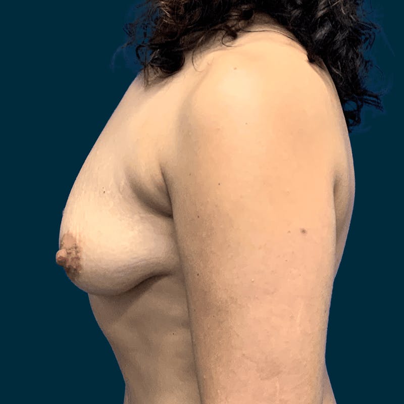 Breast Lift Before & After Gallery - Patient 314514 - Image 7