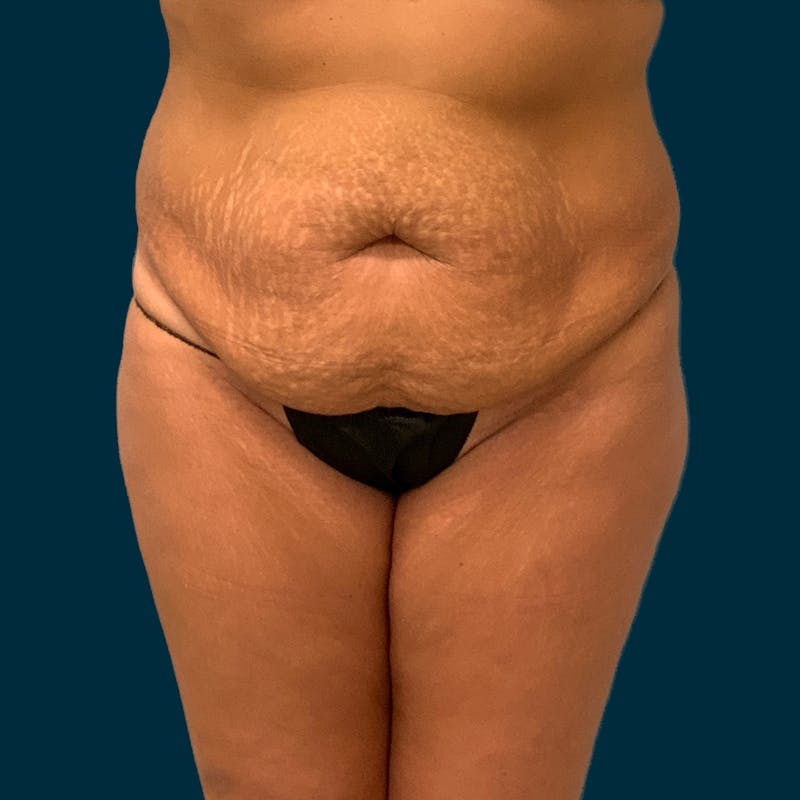 Abdominoplasty Before & After Gallery - Patient 209690 - Image 1