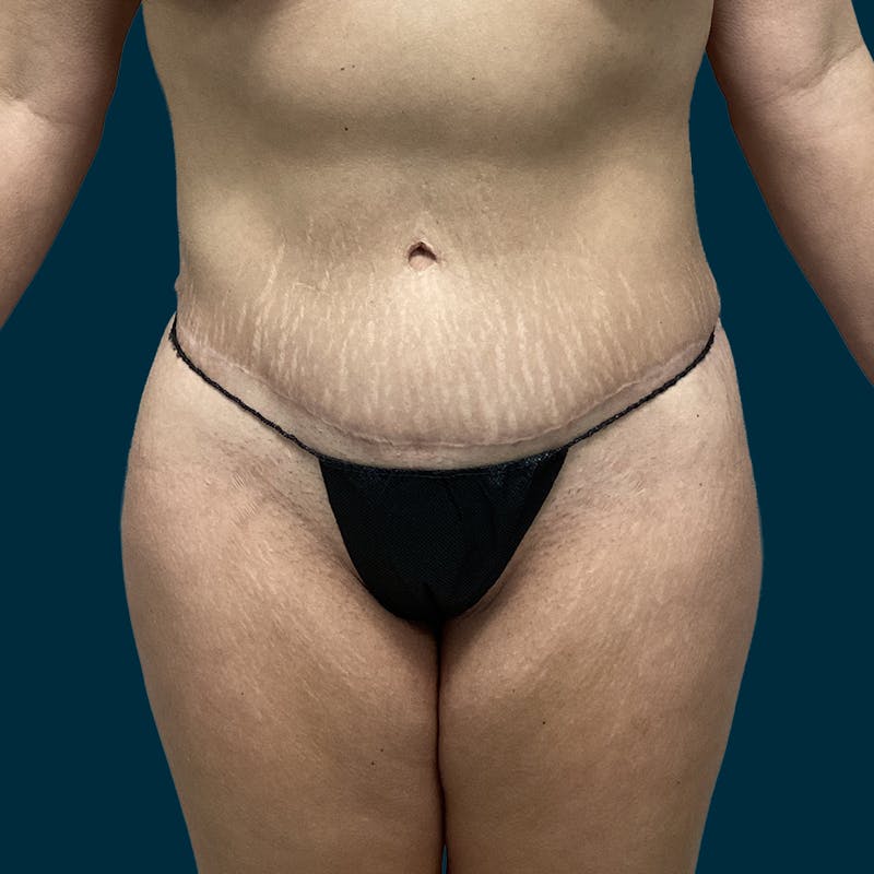 Liposuction Before & After Gallery - Patient 904689 - Image 2
