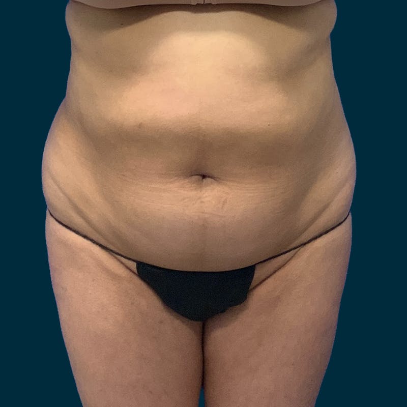 Abdominoplasty Before & After Gallery - Patient 376713 - Image 1