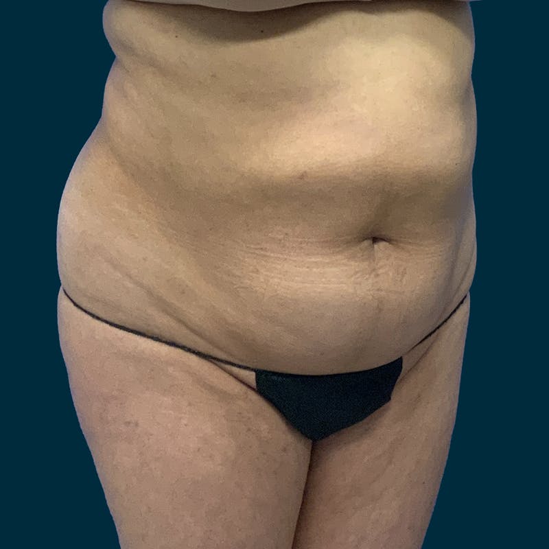 Abdominoplasty Before & After Gallery - Patient 376713 - Image 3