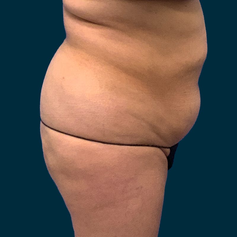 Abdominoplasty Before & After Gallery - Patient 376713 - Image 5