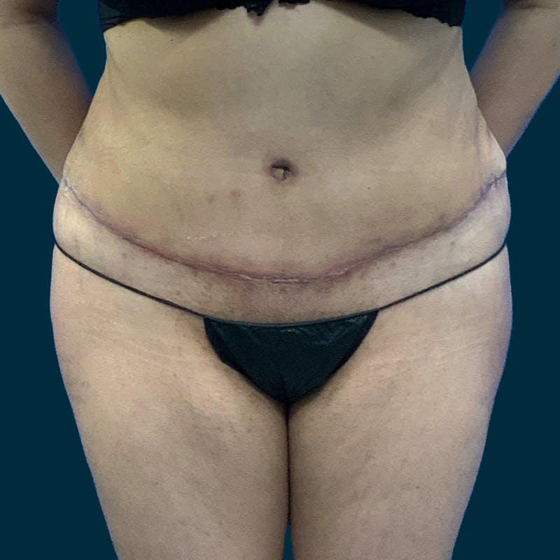 Abdominoplasty Before & After Gallery - Patient 376713 - Image 2