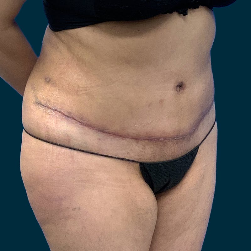 Abdominoplasty Before & After Gallery - Patient 376713 - Image 4