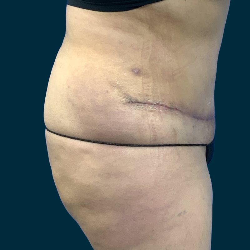 Abdominoplasty Before & After Gallery - Patient 376713 - Image 6