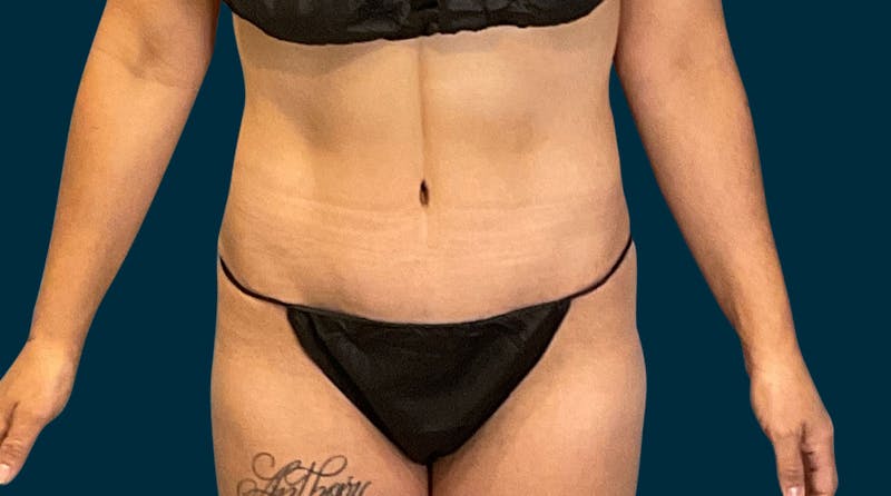 Abdominoplasty Before & After Gallery - Patient 410158 - Image 4