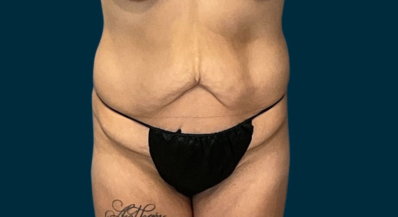 Abdominoplasty Before & After Gallery - Patient 410158 - Image 1