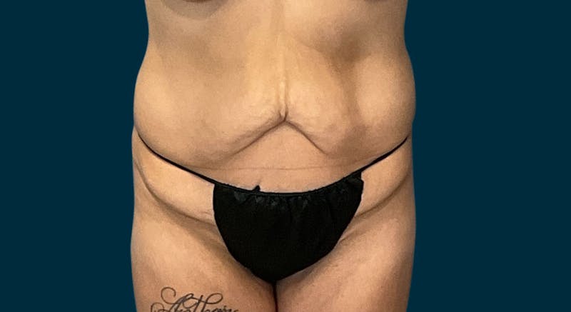 Patient u-rTb5aGRRyvSG72poqOvA - Tummy Tuck Before & After Photos