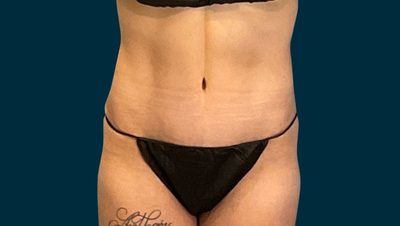 Liposuction Before & After Gallery - Patient 188710 - Image 4