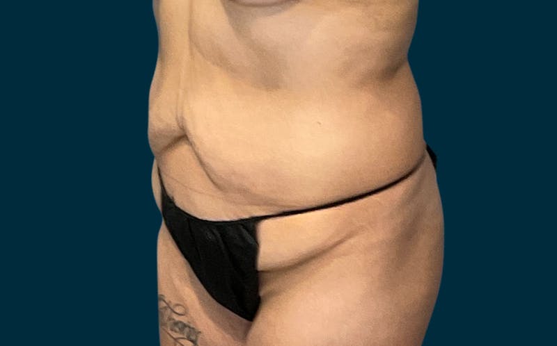 Liposuction Before & After Gallery - Patient 188710 - Image 5