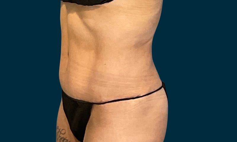 Liposuction Before & After Gallery - Patient 188710 - Image 6