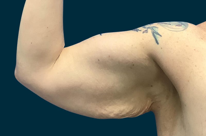 Patient 3TSNbrXlQ8K_ZBMnZ5Rhsg - Arm Lift Before & After Photos