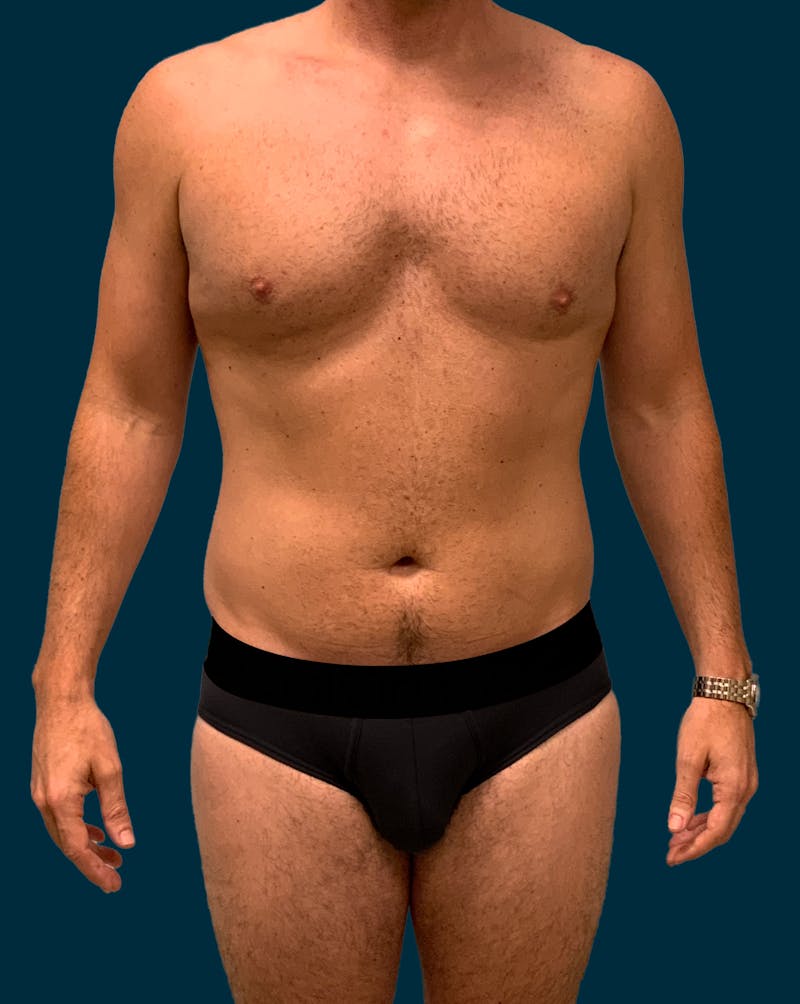 Liposuction Before & After Gallery - Patient 417909 - Image 1