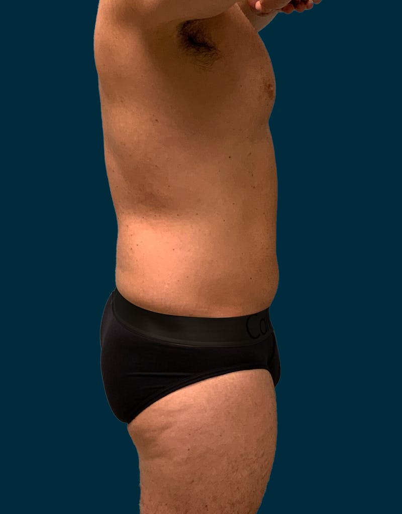 Liposuction Before & After Gallery - Patient 417909 - Image 5