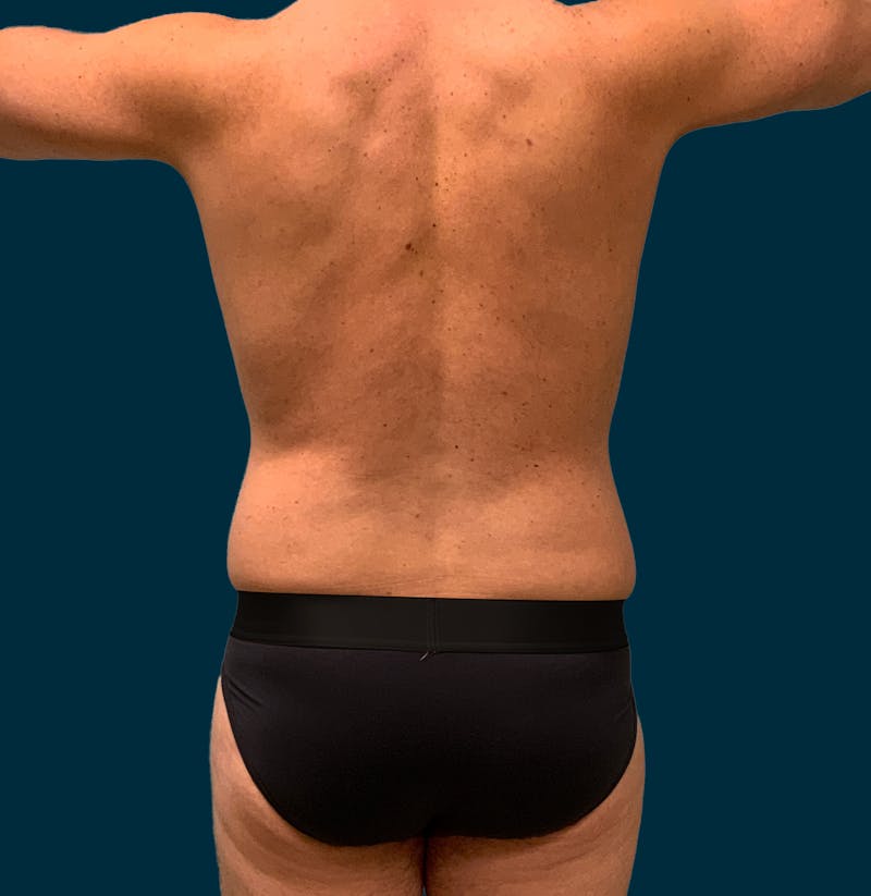 Liposuction Before & After Gallery - Patient 417909 - Image 7